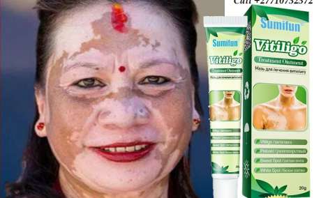 Get Rid Of Vitiligo In Vaasa City In Finland And Murphy Town in North Carolina, United States Call +27710732372 Scars And Stretch Marks In Vereeniging City In South Africa And Alleghe Village in Italy